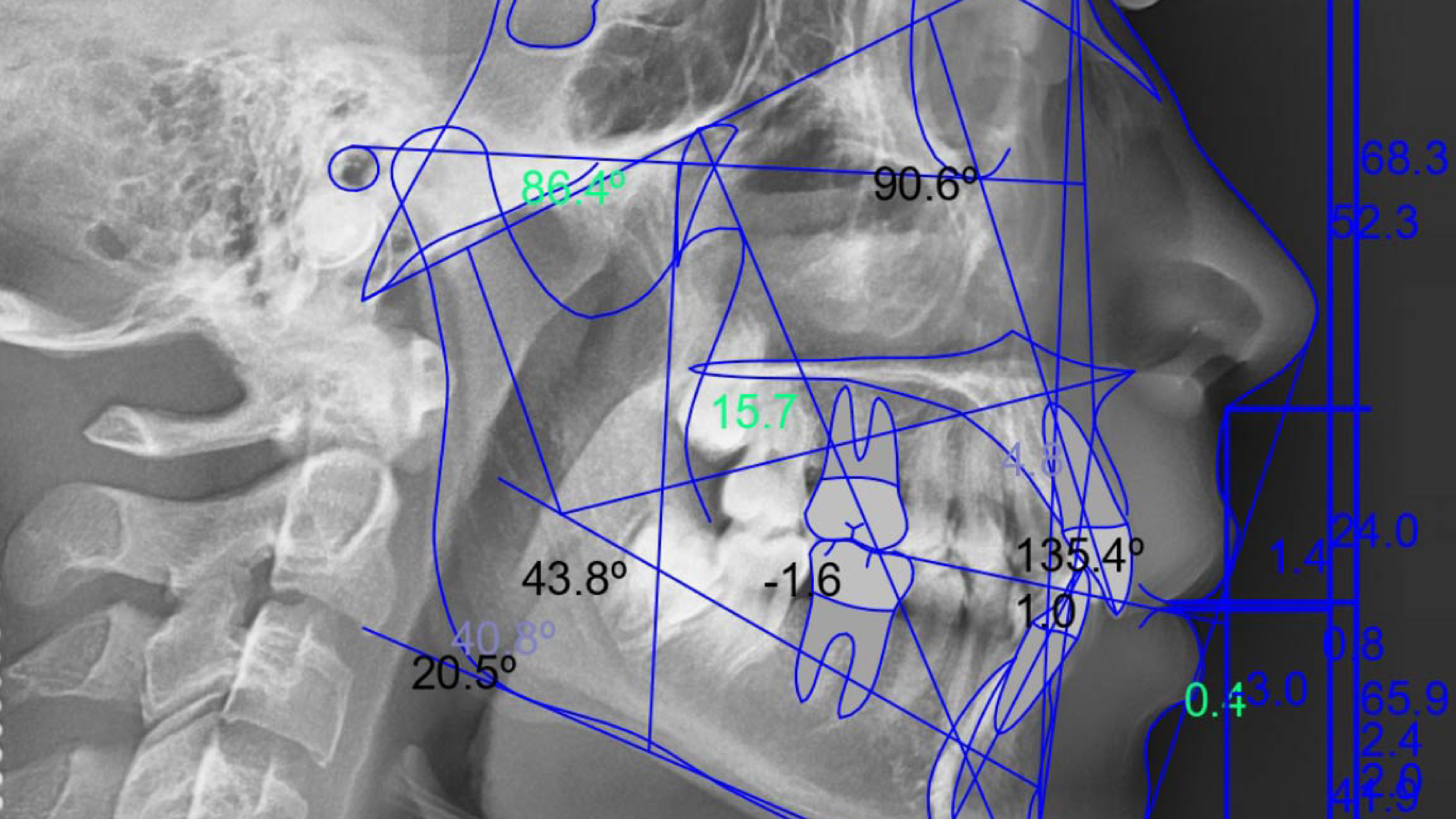 Cefalométrica Lateral + Trazado