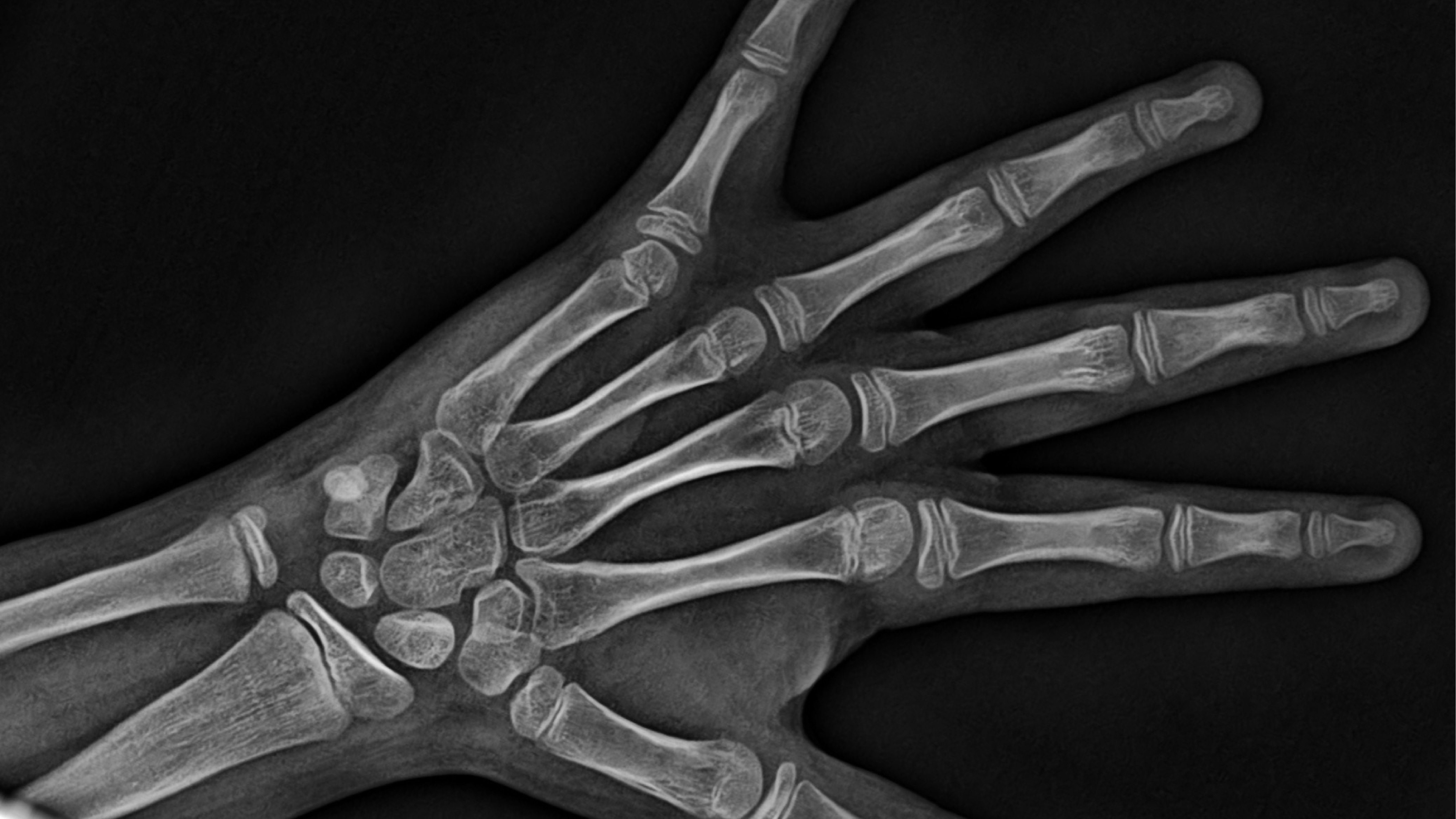 Radiografía Carpal (Maduración Ósea)
